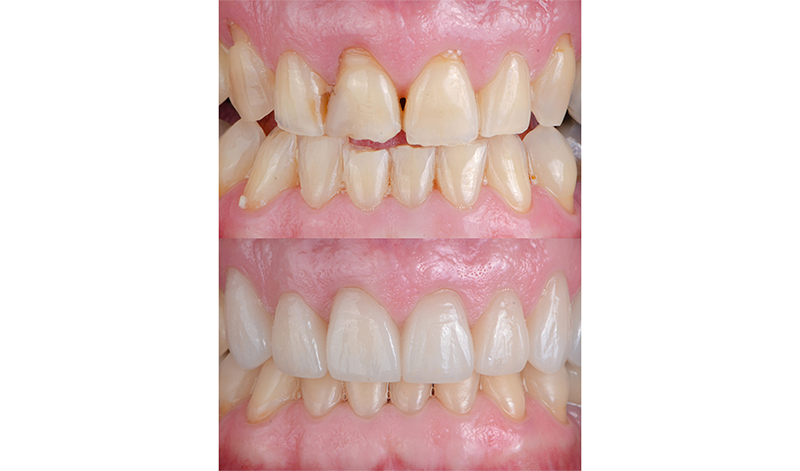 Einsatz von Keramik Veneers und Kronen