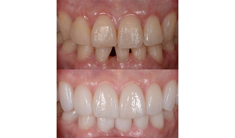 Vorher nachher von Zähnen mit Keramik Veneers