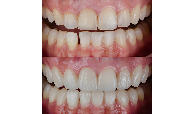 Vorher nachher Ergebnis mit Veneers und Kronen