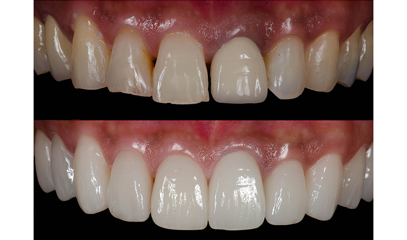 Verschönerung der Zähne, vorher nachher