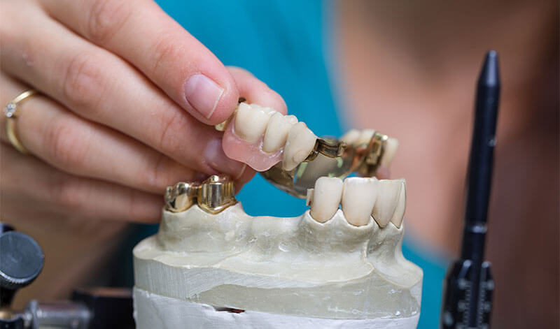 Bearbeitung und Anpassung einer Prothese